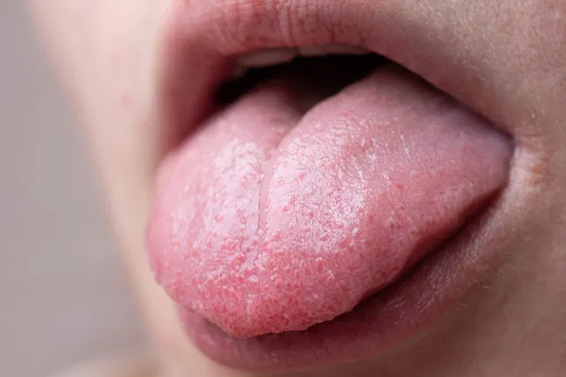 Herpes on the Tongue